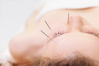 facial acupuncture